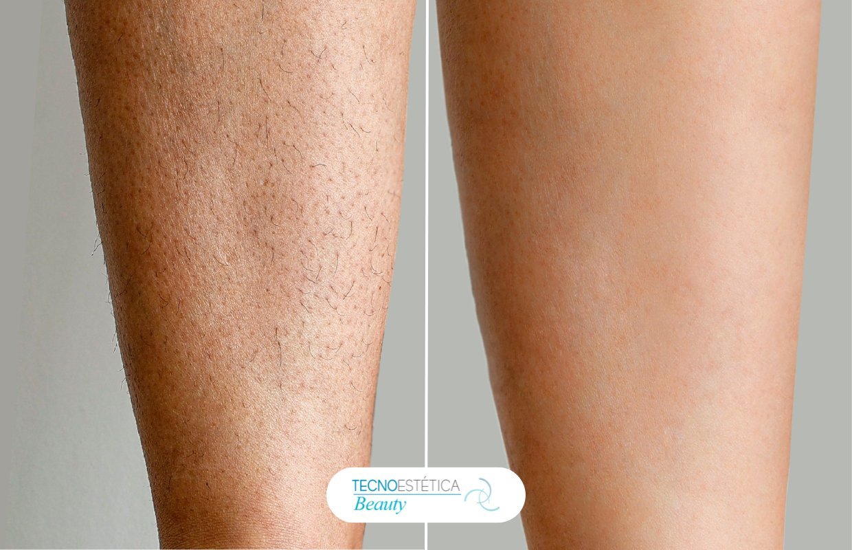 Antes y después depilación láser pierna en Barcelona